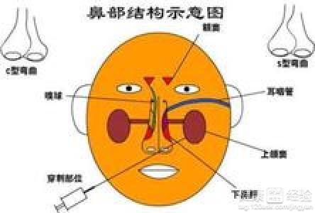 鼻窦炎有哪些症状用什么药治疗,鼻窦炎的症状、治疗与用药全面分析说明,系统解答解释定义_版章90.87.11