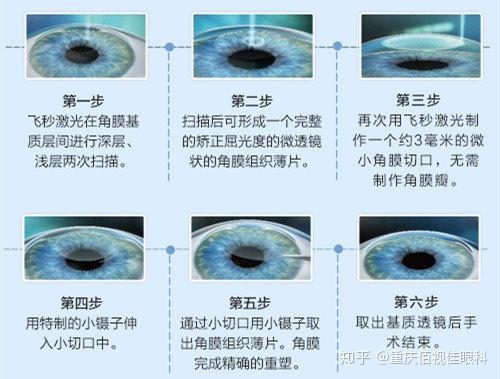 激光手术飞秒和全准激光的区别,激光手术飞秒与全准激光的区别及快速响应方案落实探讨,稳定性设计解析_V223.80.25