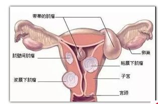 子宫内膜增厚是什么意思