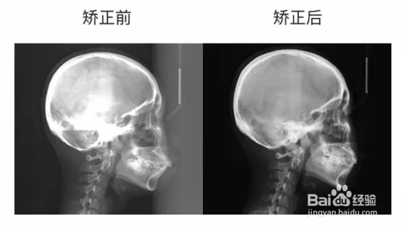 前方牵引矫治器