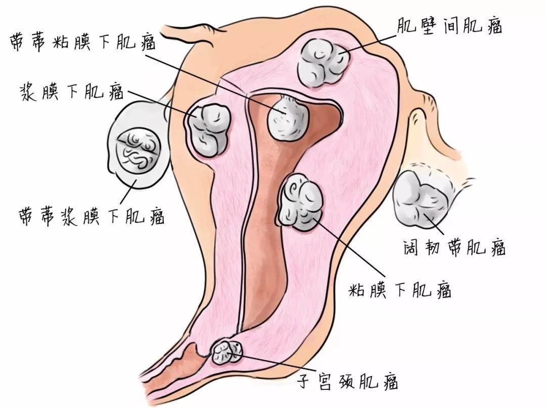 子宫肌瘤咨询免费专家,子宫肌瘤咨询免费专家，深度解析与数据执行研究,创新策略解析_云端版21.84.98