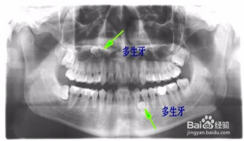 多生牙拔除大概需要多少费用